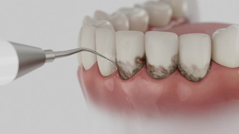 Trusted Wisdom Tooth Removal service in New Berlin, WI - Dentist Open Now